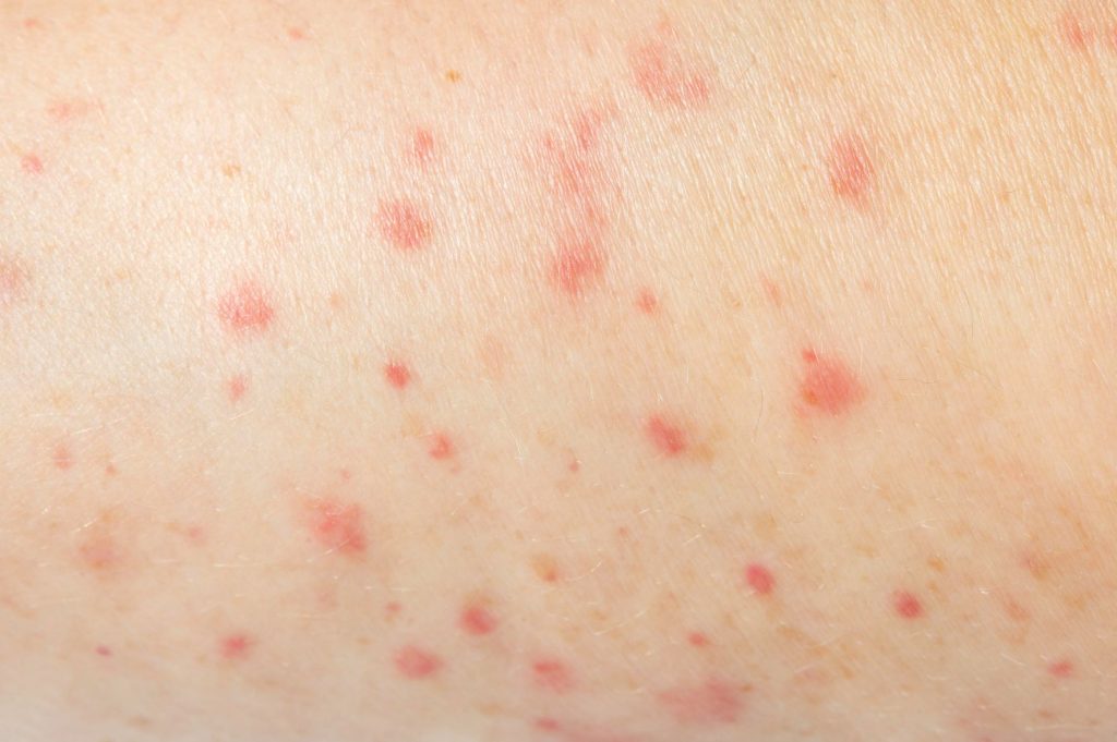 Person having a skin allergy close-up